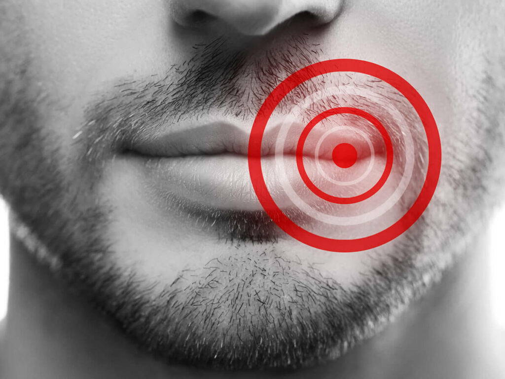 photo shows man with a cold sore
