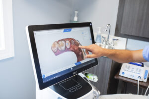 photo of cerec scanner use on dental procedures